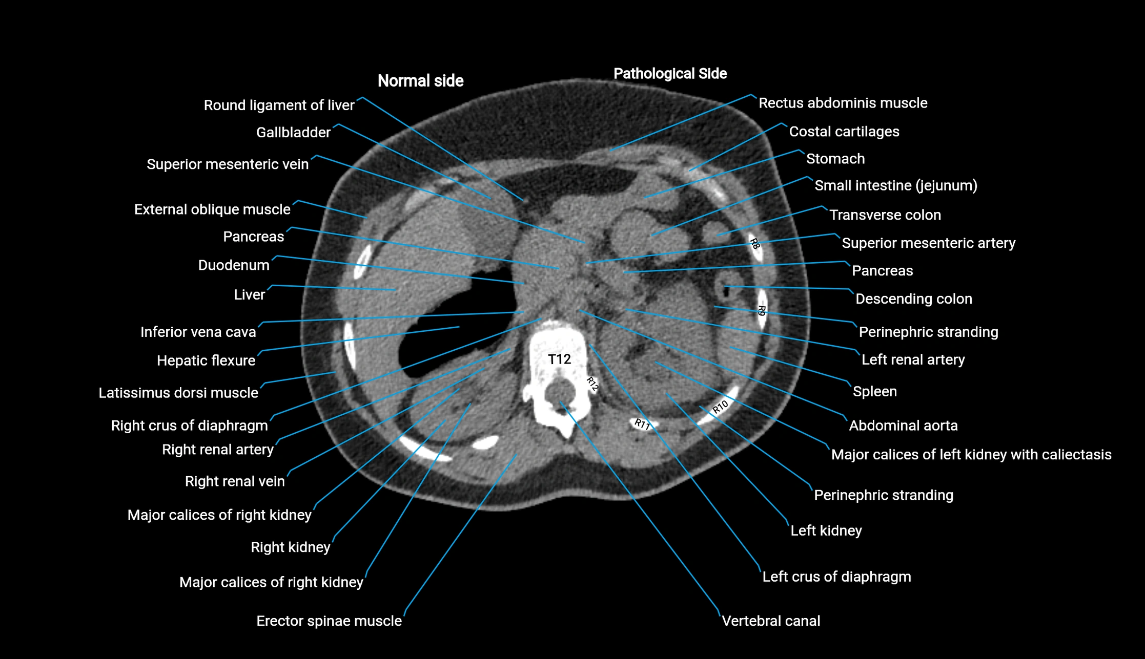 CT KUB axial cross sectional anatomy  radiology image -img-00201-00031.webp